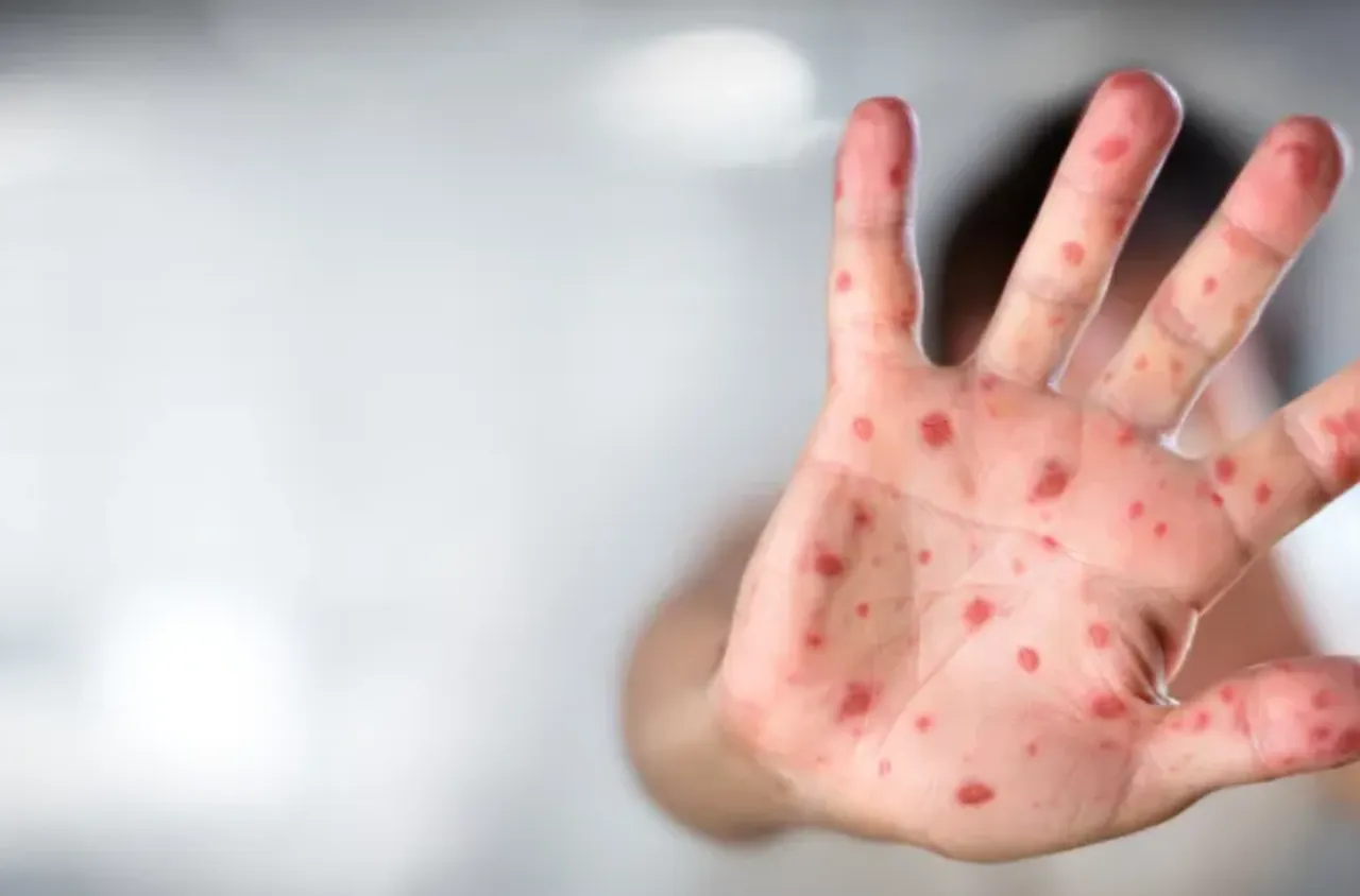 Продължават да растат заразените с морбили